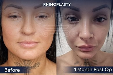 before-after photo rhinoplasty-nose-job
