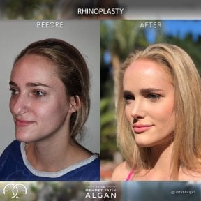 before-after photo rhinoplasty-nose-job