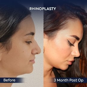 before-after photo rhinoplasty-nose-job