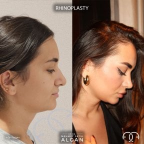 before-after photo rhinoplasty-nose-job