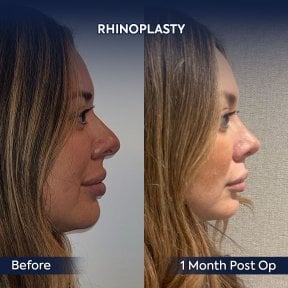 before-after photo rhinoplasty-nose-job