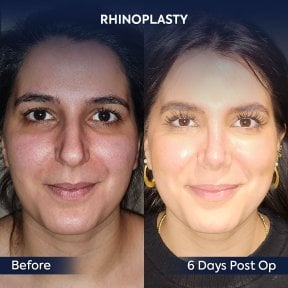 before-after photo rhinoplasty-nose-job
