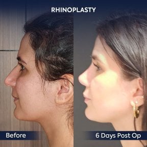 before-after photo rhinoplasty-nose-job