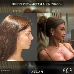 before-after photo rhinoplasty-nose-job