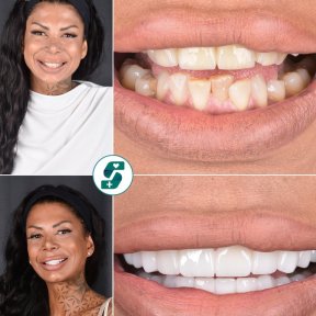 before-after photo zirconia-crown-installation