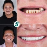 Before and after dental implant results at Soraca Med – restored smile and improved teeth