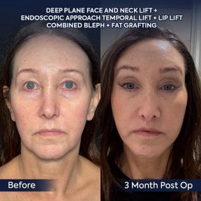 before-after photo lipomodelirovanie-lica