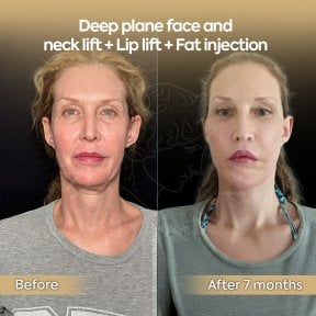 before-after photo lipomodelirovanie-lica