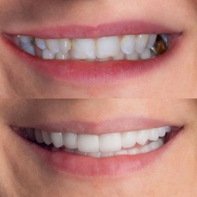 before-after photo emax-veneers