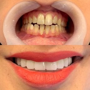 before-after photo emax-veneers