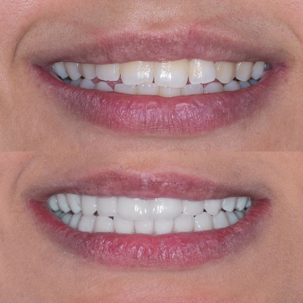 نتائج قبل وبعد فينير إيماكس في Tower Dental Clinic، تحول طبيعي للابتسامة