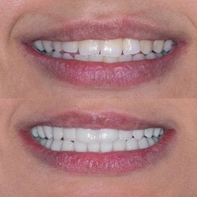 before-after photo emax-veneers