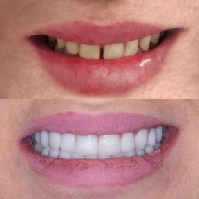 before-after photo emax-veneers