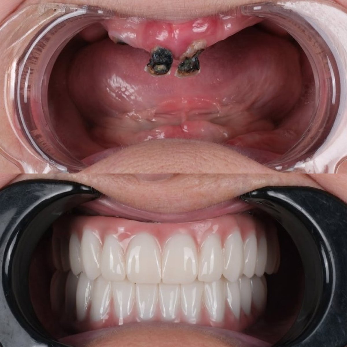 Resultado antes y después de implantes dentales All-on-6 en un día en Antalya Smile Designs
