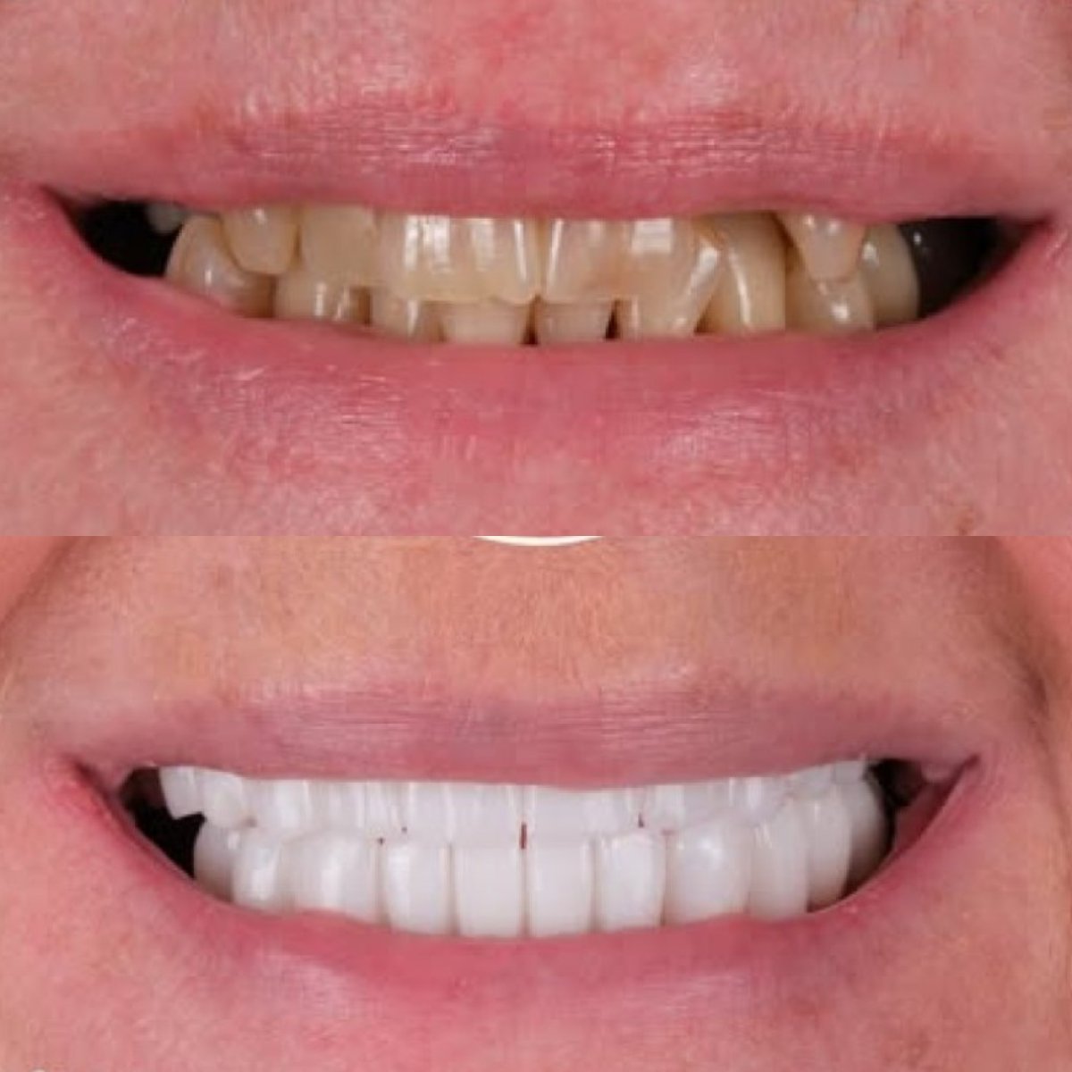 نتائج قبل وبعد تجميل الابتسامة في Antalya Smile Designs – أسنان أكثر بياضًا وتناسقًا