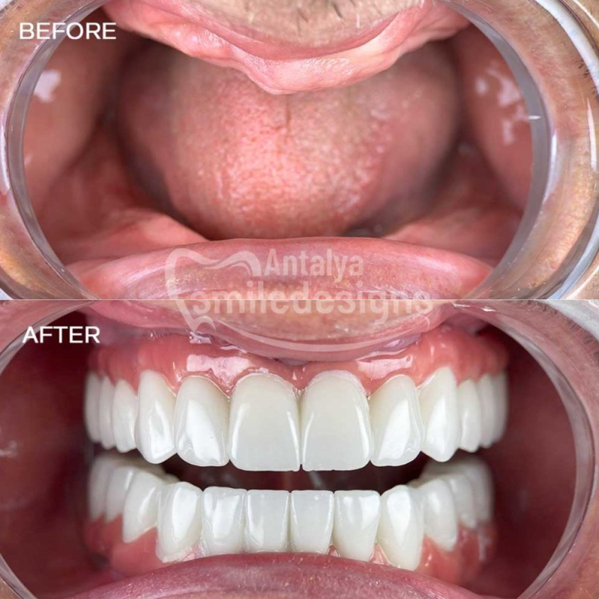 نتائج قبل وبعد تركيب أطقم الأسنان الكاملة في Antalya Smile Designs، ابتسامة مستعادة