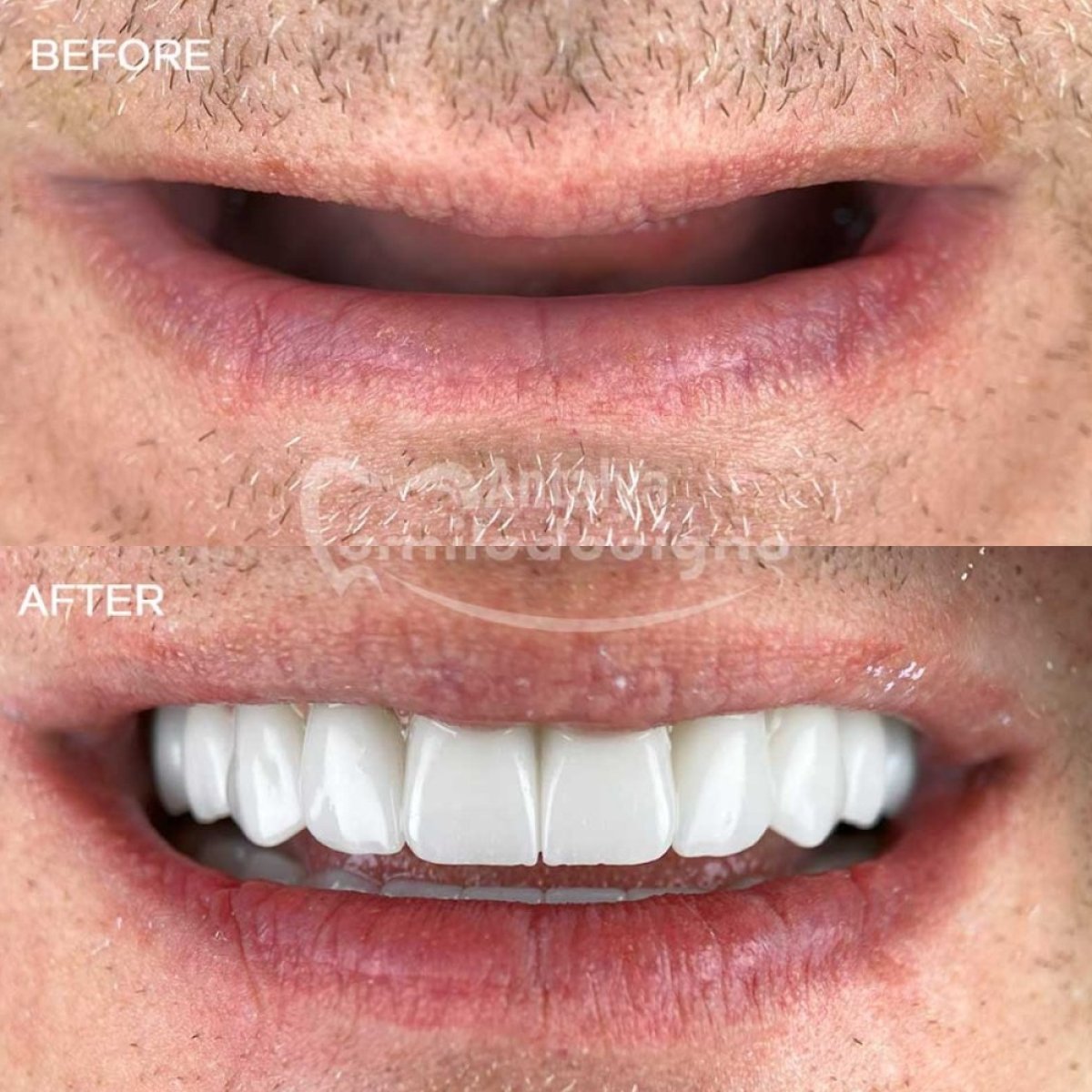 Resultado antes y después de prótesis dentales completas en Antalya Smile Designs, sonrisa restaurada