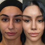 نتائج تجميل الأنف قبل وبعد في Ali Cetinkaya M.D.، إعادة تشكيل وتحسين الأنف