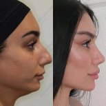 نتائج تجميل الأنف قبل وبعد في عيادة Ali Cetinkaya M.D.، إعادة تشكيل الأنف بمظهر طبيعي