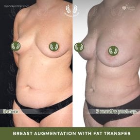 before-after photo 360-liposuction