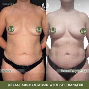 before-after photo 360-liposuction