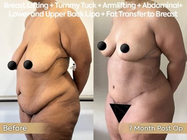 before-after photo 360-liposuction