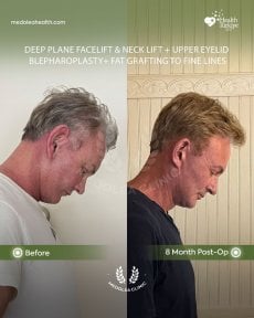 before-after photo podtazka-kozi-lica-fejslift