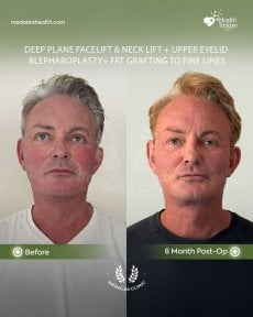before-after photo podtazka-kozi-lica-fejslift