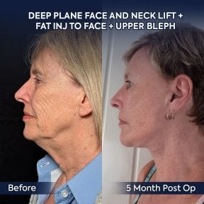 before-after photo podtazka-kozi-lica-fejslift