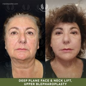 before-after photo podtazka-kozi-lica-fejslift