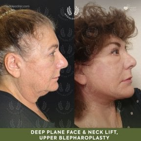 before-after photo podtazka-kozi-lica-fejslift