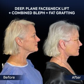 before-after photo podtazka-kozi-lica-fejslift