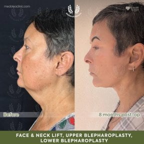 before-after photo podtazka-kozi-lica-fejslift
