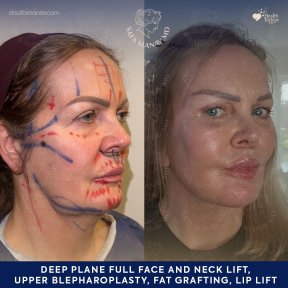 before-after photo glubokaya-podtyazhka-lica-deep-plane-facelift