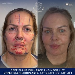 before-after photo glubokaya-podtyazhka-lica-deep-plane-facelift