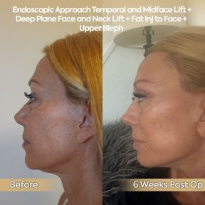 before-after photo glubokaya-podtyazhka-lica-deep-plane-facelift