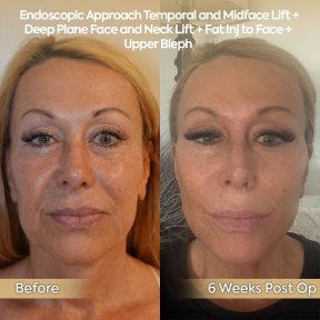 before-after photo glubokaya-podtyazhka-lica-deep-plane-facelift