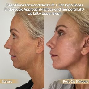 before-after photo glubokaya-podtyazhka-lica-deep-plane-facelift