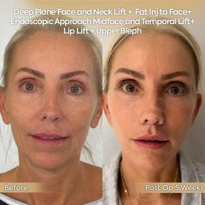 before-after photo glubokaya-podtyazhka-lica-deep-plane-facelift