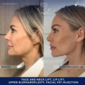 before-after photo glubokaya-podtyazhka-lica-deep-plane-facelift