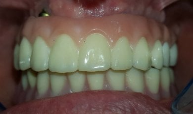 before-after photo all-on-6-dental-implants