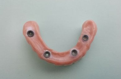 before-after photo all-on-6-dental-implants