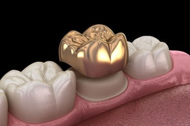 before-after photo teeth-cleaning
