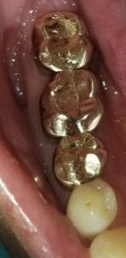 before-after photo teeth-cleaning