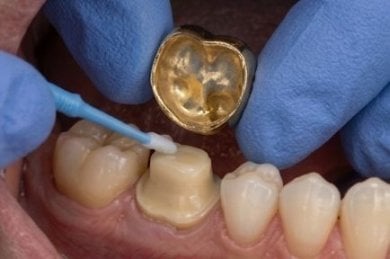 before-after photo teeth-cleaning