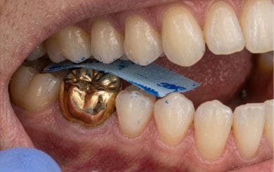 before-after photo teeth-cleaning