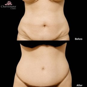 نتائج شفط الدهون قبل وبعد في Charismma Clinic – تحسين شكل البطن