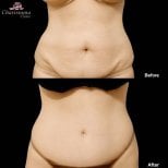 نتائج شفط الدهون قبل وبعد في Charismma Clinic – تحسين شكل البطن