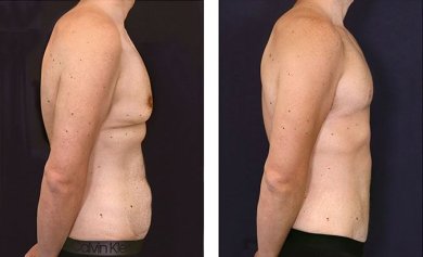 before-after photo gynecomastia-surgery