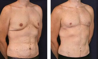 before-after photo gynecomastia-surgery